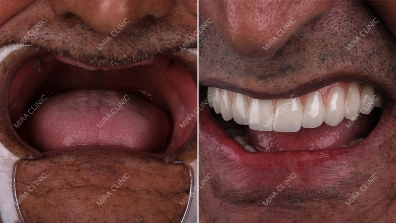 Full Mouth Dental Implants